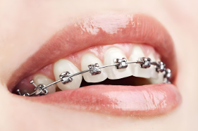 金屬托槽/陶瓷托槽矯正